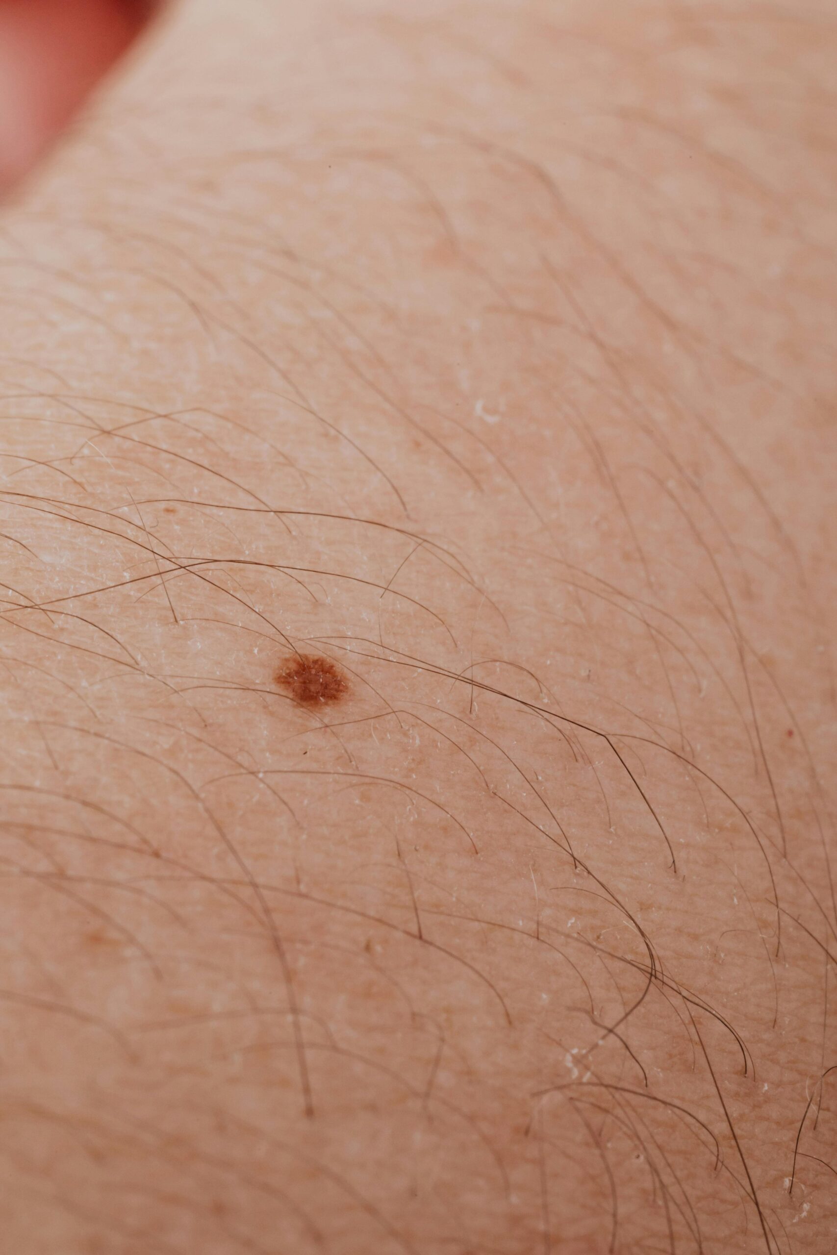 Detailed close-up image of a mole on human skin, ideal for dermatology topics.